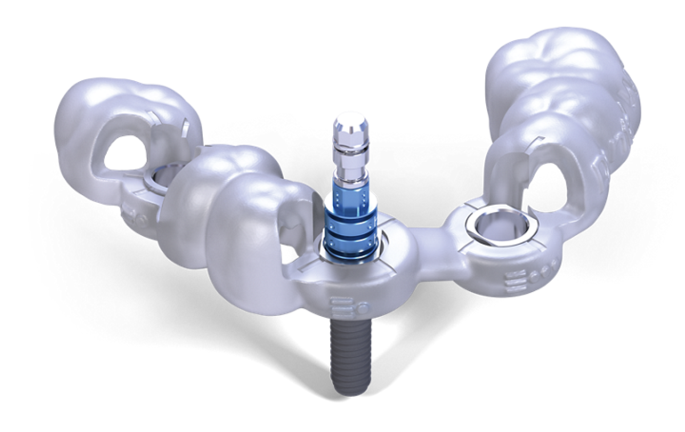 3D数字化牙种植导板